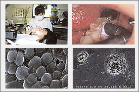 ティースクリーニング (歯石除去)